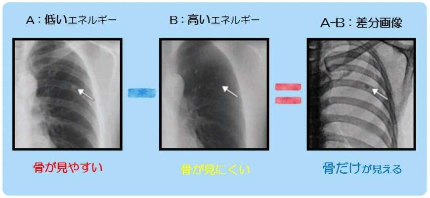 %e3%80%90dual-energy-imaging%e3%80%91%e3%83%87%e3%83%a5%e3%82%a2%e3%83%ab%e3%82%a8%e3%83%8a%e3%82%b8%e3%83%bc%e6%92%ae%e5%bd%b1%e3%81%a8%e3%81%af%ef%bc%9f-2