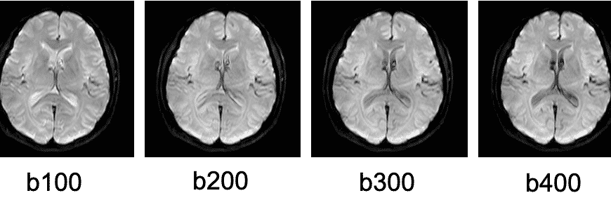 mri%e5%8e%9f%e7%90%86%e3%89%91%ef%bc%9a%e6%8b%a1%e6%95%a3%e5%bc%b7%e8%aa%bf%e7%94%bb%e5%83%8f%e3%81%a8%ef%bd%82%e5%80%a4%e3%81%ae%e9%96%a2%e4%bf%82%e3%81%a8%e3%81%af%ef%bc%9f-2