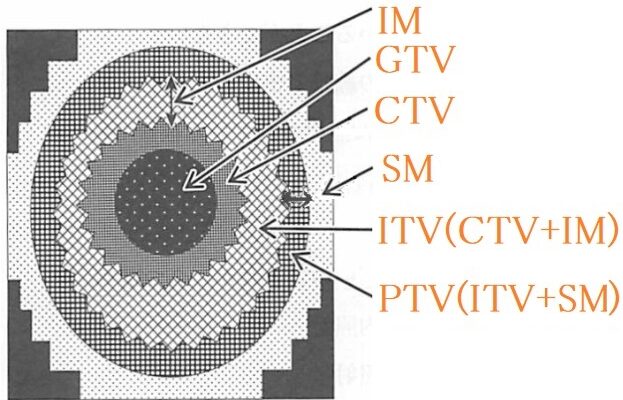 放射線治療 各種体積の線量とは ギモンらど