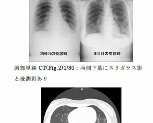 X線画像 レントゲン の白黒の違いとは ギモンらど